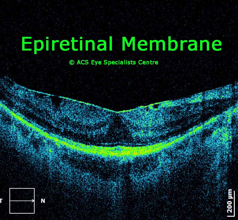 OCT Epiretinal membrane